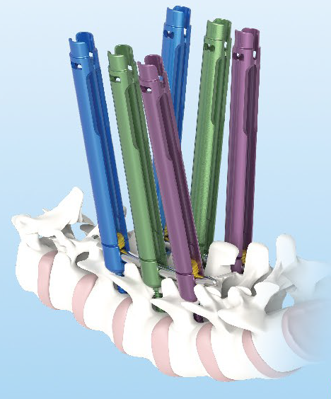 Малоінвазивна система для транспедикулярної фіксації хребта (6 гвинтів) UMP